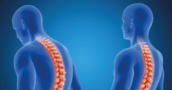 Cómo vivir con artrosis de columna cuando la padeces